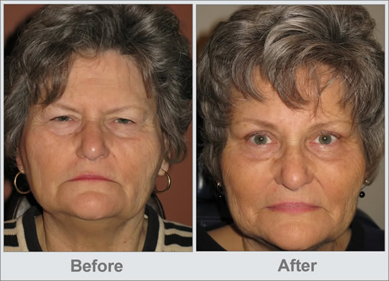 lift ptosis brow cosmetic procedures eyebrow before eyelid
